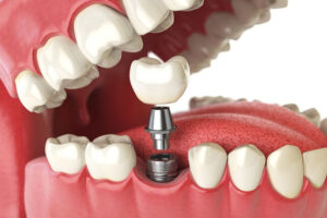 a single dental implant post and crown in a lower arch graphic.