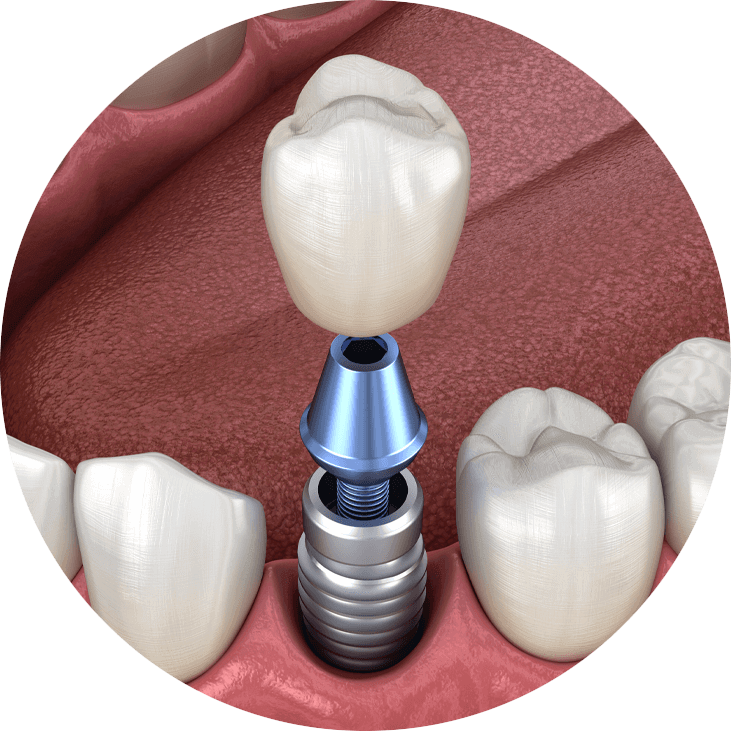 dental implants model