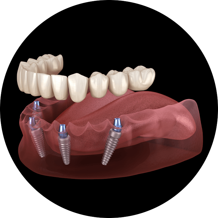 full arch implant 3d model