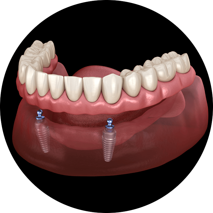 implant supported dentures 3d model
