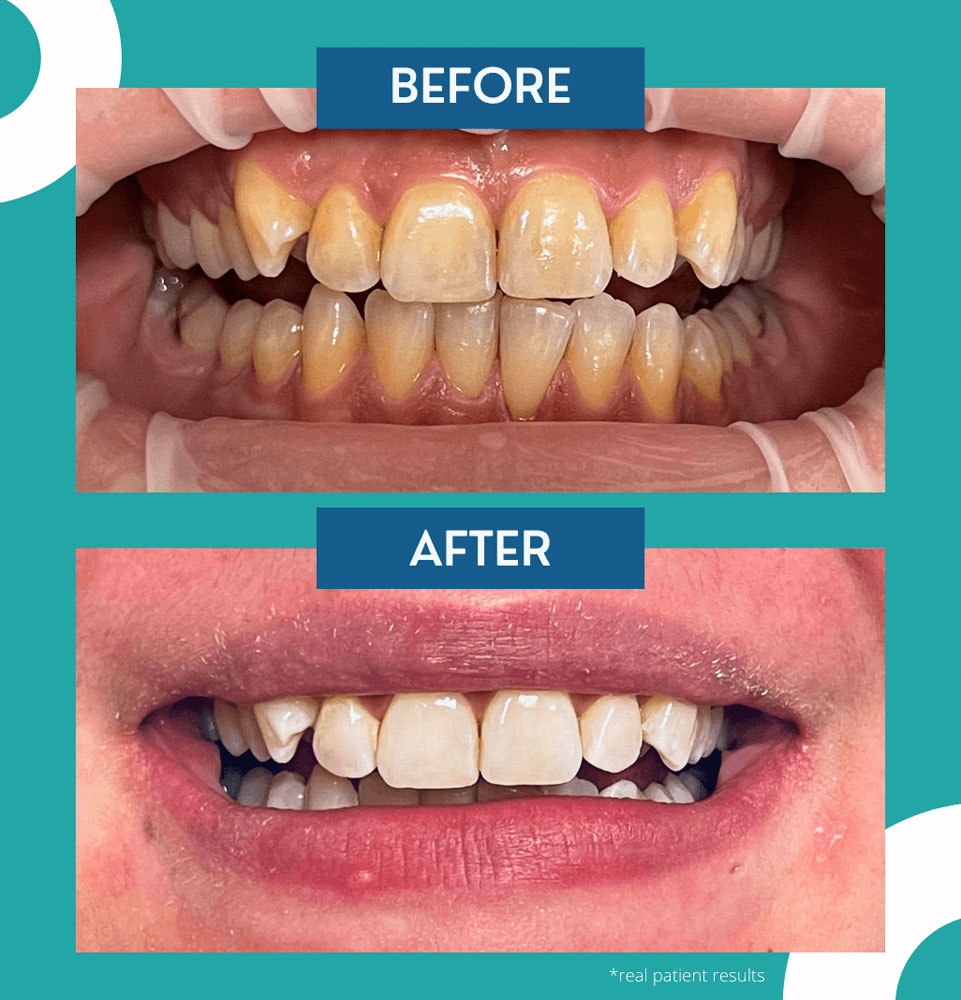 riverside dental dr blanchard before after complete