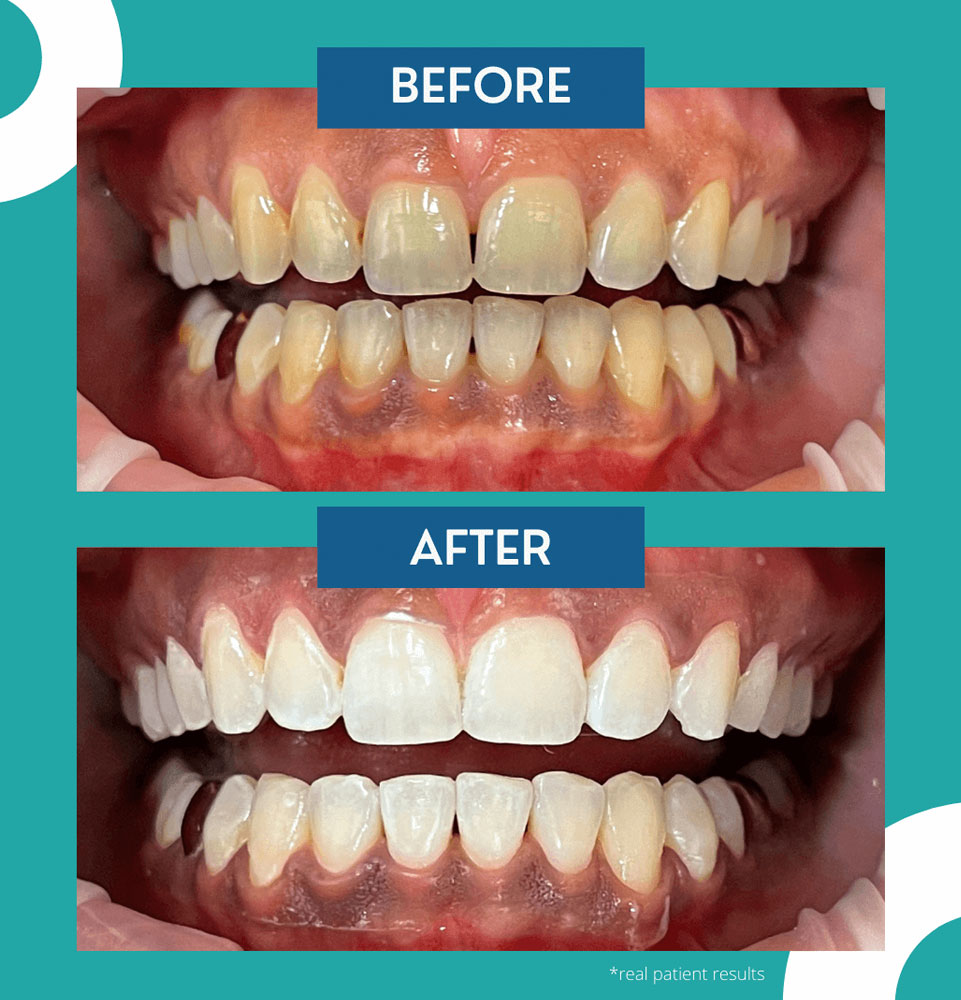 riverside dental dr blanchard before after complete 4