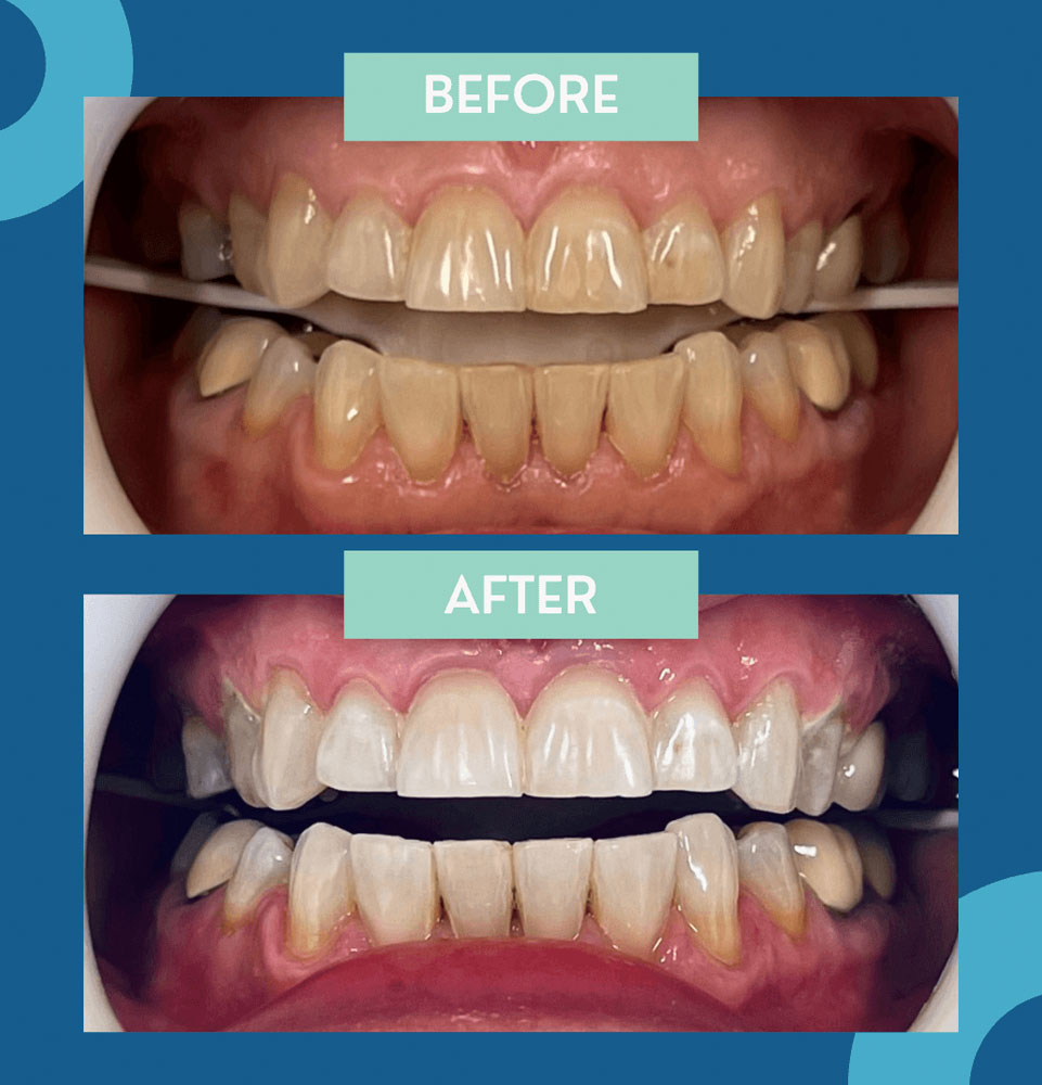 riverside dental dr blanchard before after complete 5