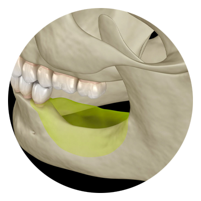 ridge augmentation 3d model