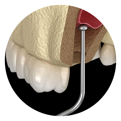 sinus lift 3dmodel