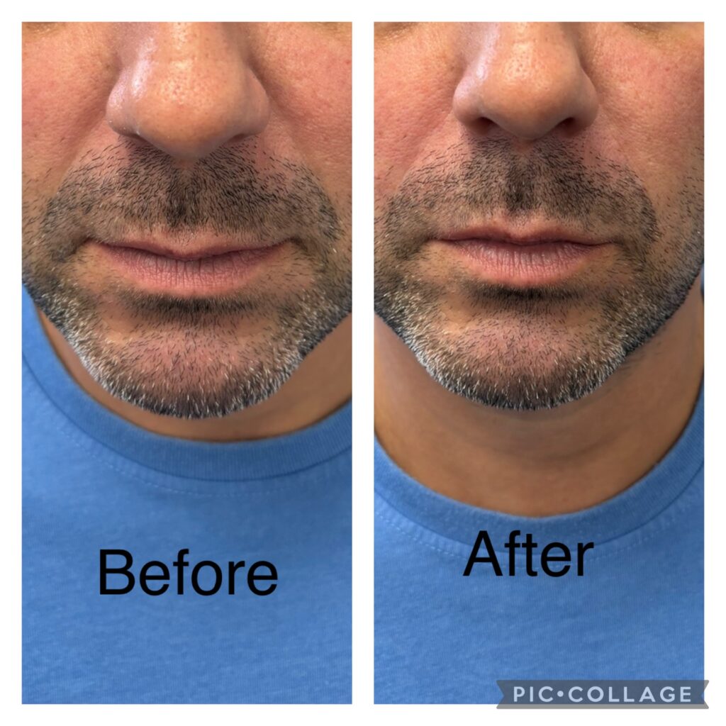 A "before and after" comparison of a man's lower face, showing treatment results, possibly at Riverside Family Dental