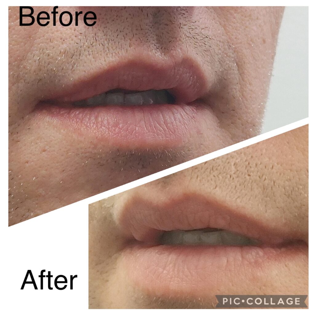 A "before and after" close-up of a person's lips, showing treatment effects, possibly at Riverside Family Dental