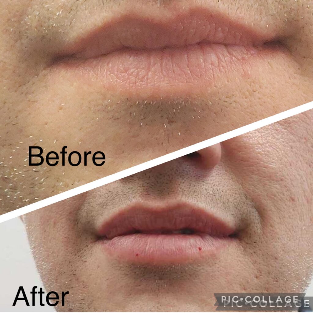 A "before and after" comparison of a person's lips, indicating treatment results, possibly at Riverside Family Dental