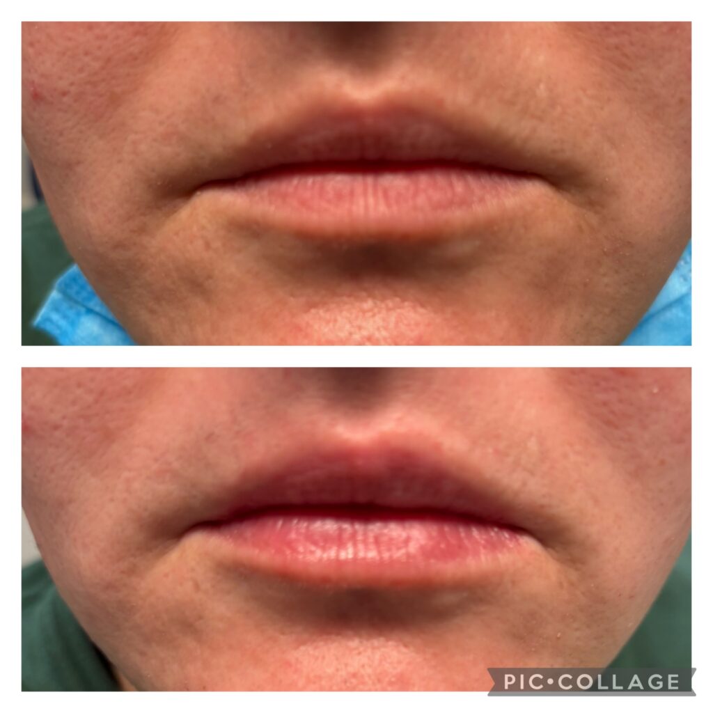 A "before and after" close-up of a person's lips, likely showing results from treatment at Riverside Dental