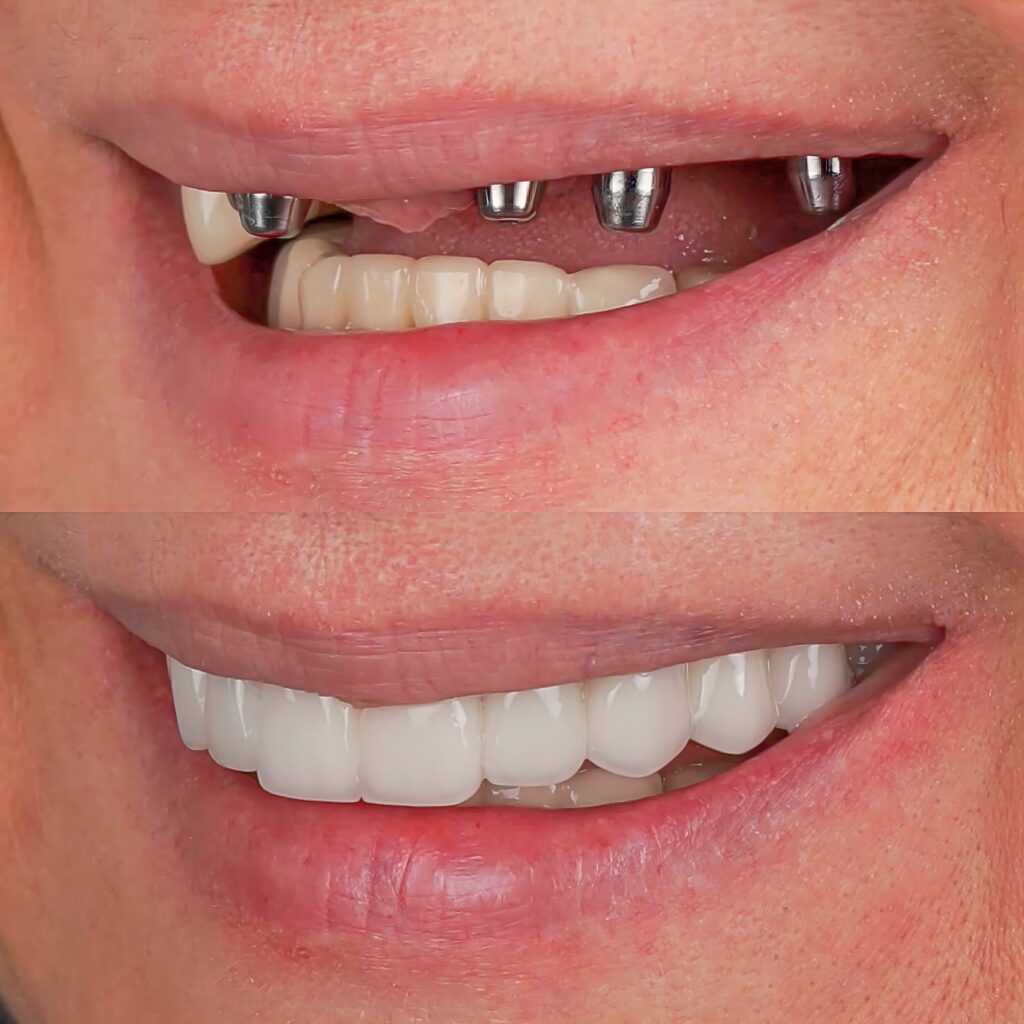 All-on-4 Dental Implants Menomonee